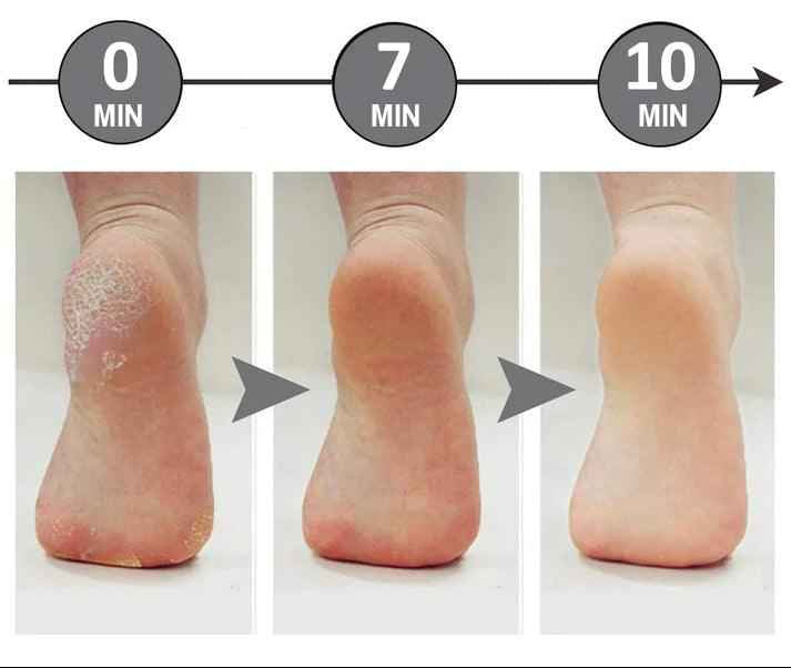 Râpe Pieds Électrique – LED – Rechargeable