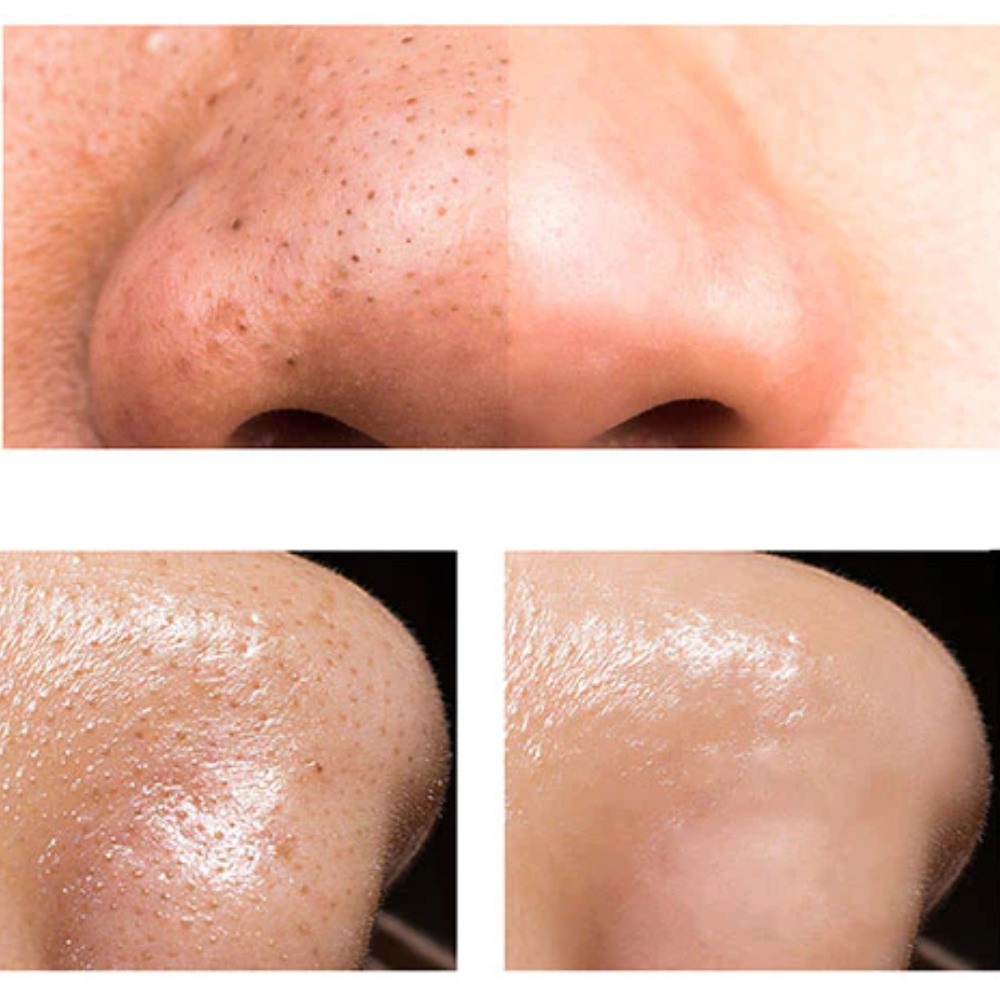 Aspirateur Points Noirs – Aspiration Réglable – Rechargeable USB