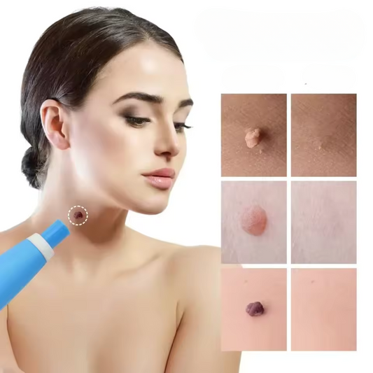 Éliminateur d’acrochordons VerrueStop  | Sans douleur, sans coupure, pour le visage et le corps