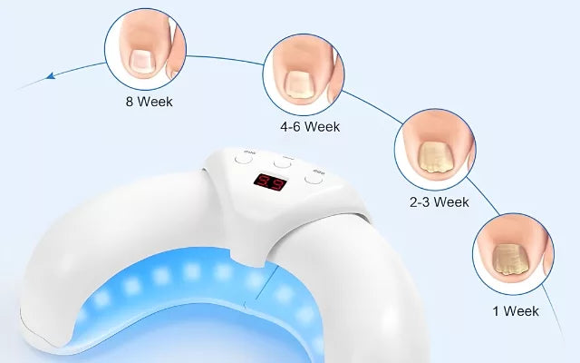 Appareil Ongles Mycose Lumière LED