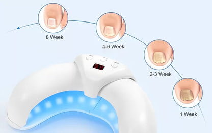 Appareil Ongles Mycose Lumière LED