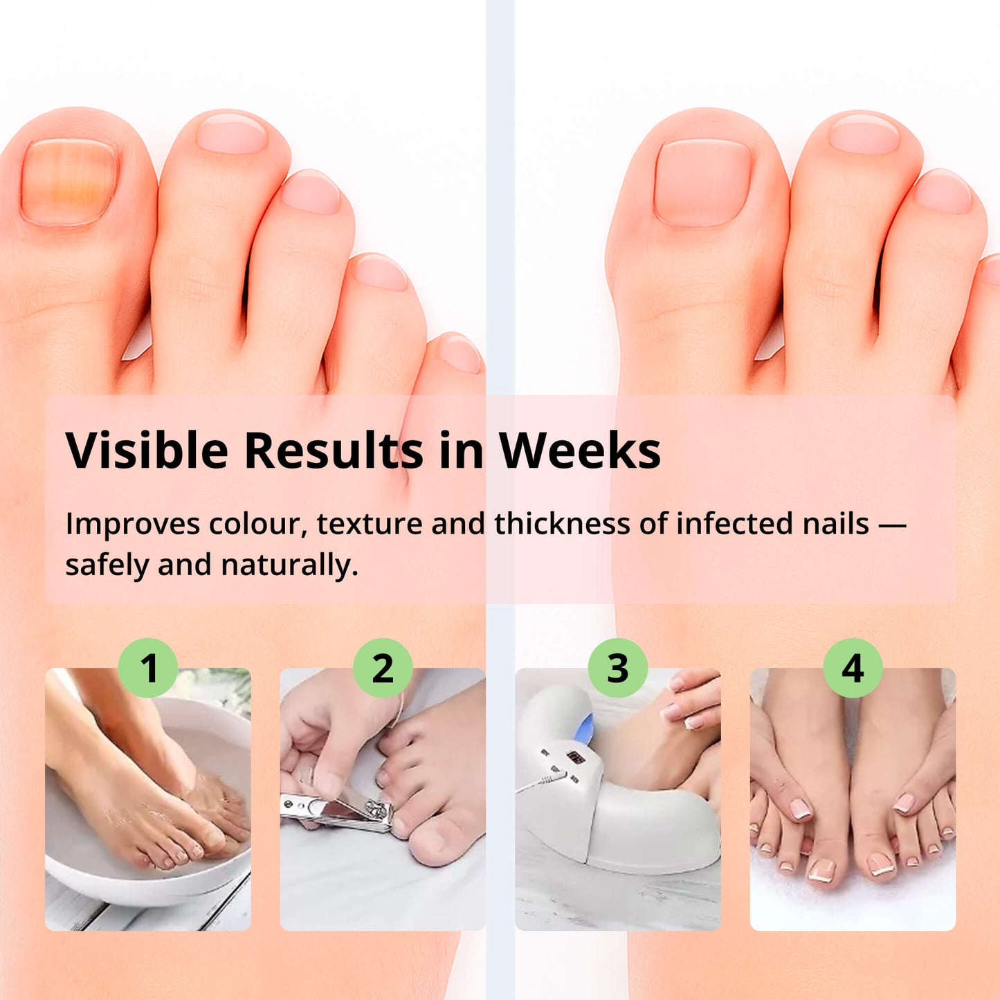 Appareil Ongles Mycose Lumière LED